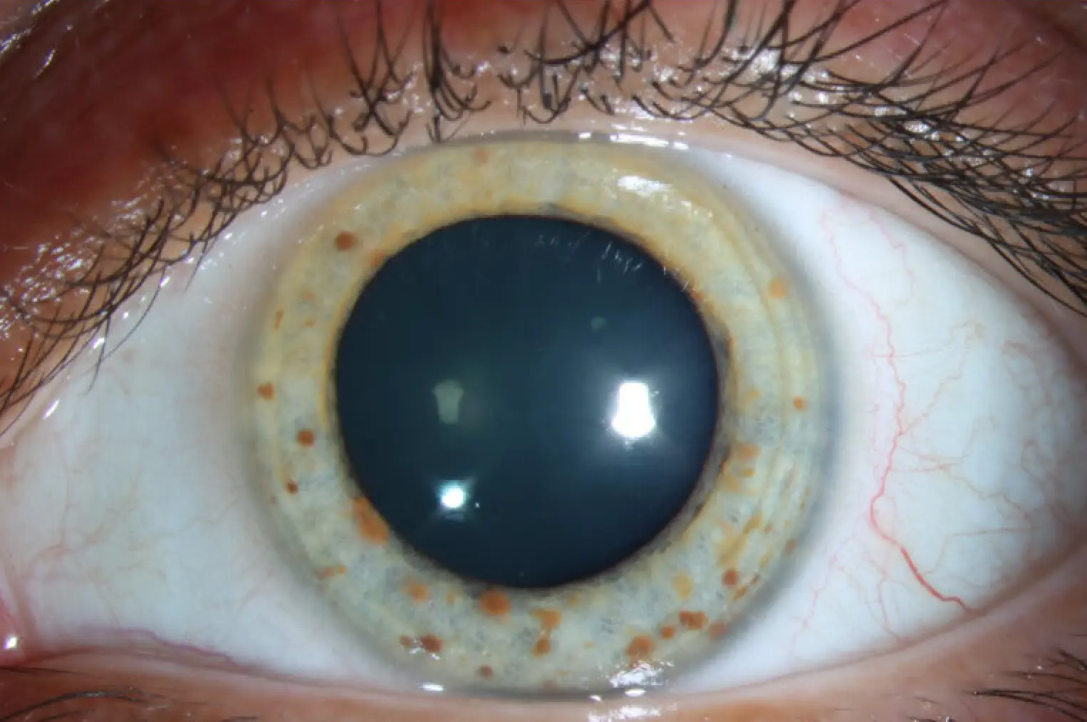 Slit lamp photography demonstrating Lisch nodules