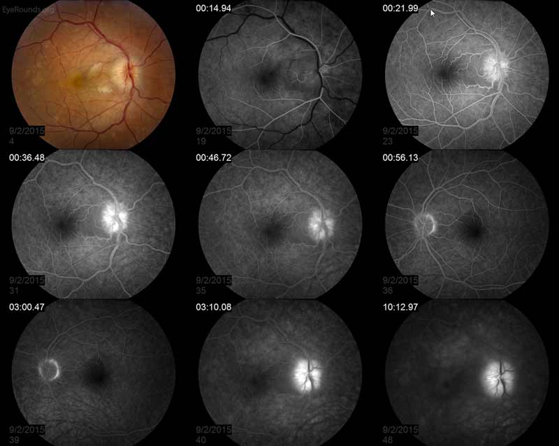 Multiple evanescent white dot syndrome (MEWDS) fundus FA