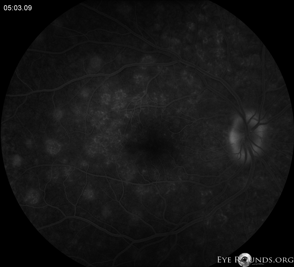 Multiple evanescent white dot syndrome (MEWDS) Fundus fluorescein angiography (FFA) late