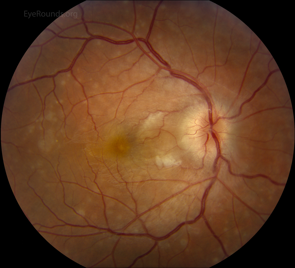 Multiple evanescent white dot syndrome (MEWDS) fundus 