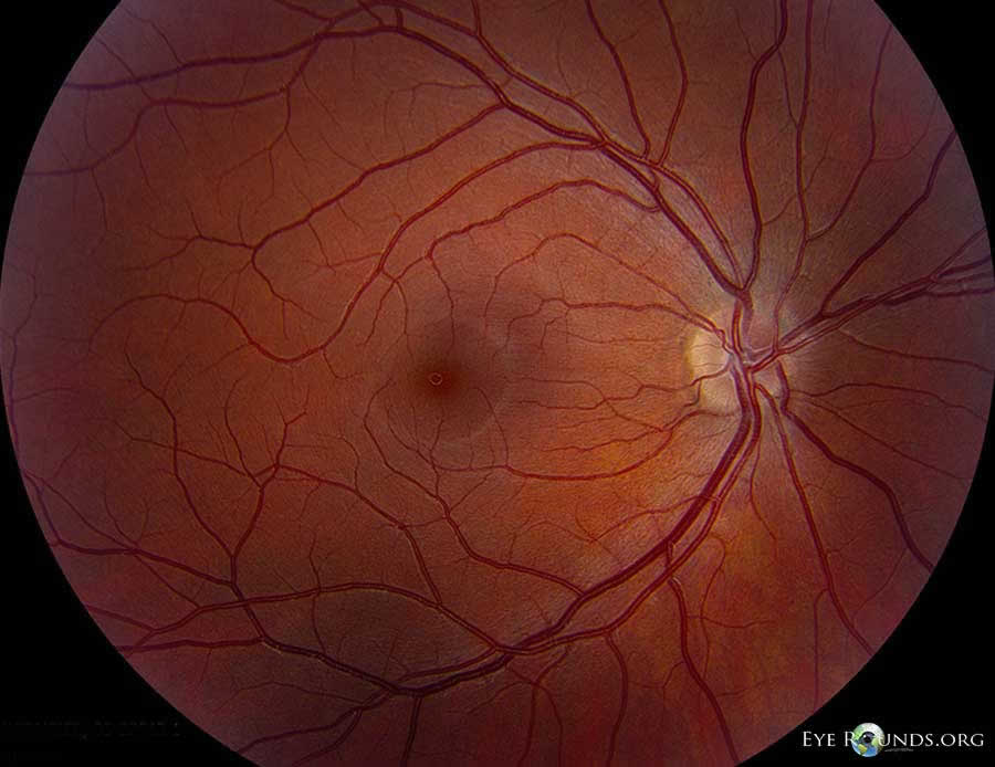 Multiple evanescent white dot syndrome (MEWDS) fundus normal