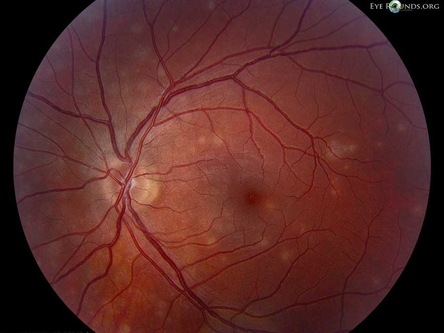 Multiple evanescent white dot syndrome (MEWDS) fundus abnormal with white spots