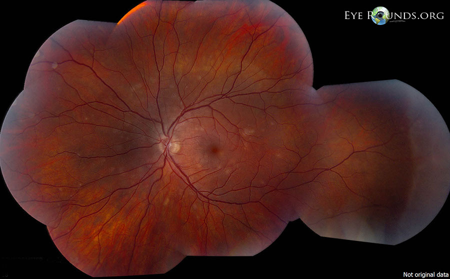 Multiple evanescent white dot syndrome (MEWDS) fundus