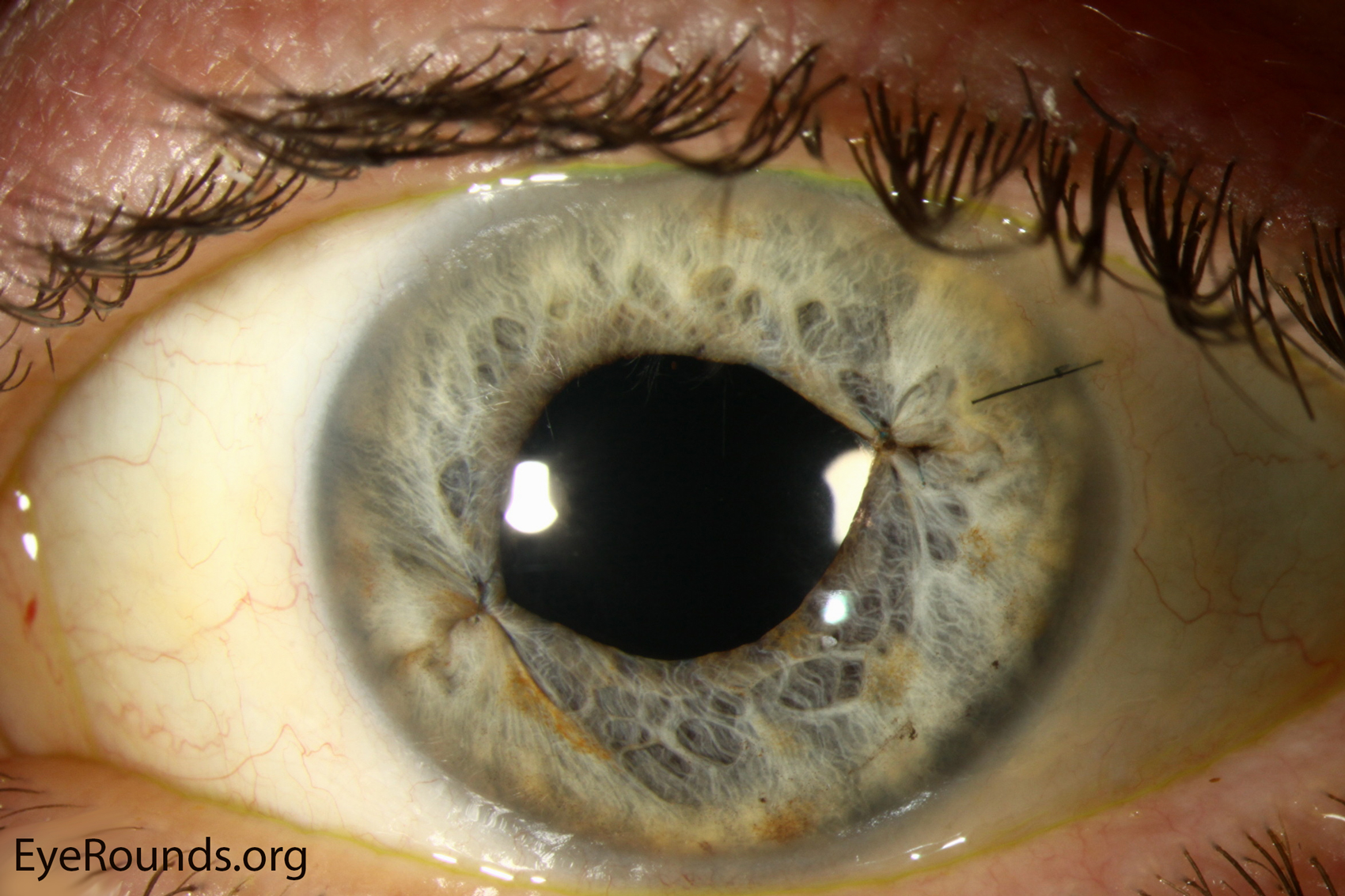 Cataract Surgery Stitches At Ann Burkett Blog Cataract Surgery Stitches At Ann Burkett Blog
