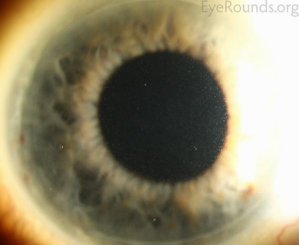 Meesmann Epithelial Corneal Dystrophy