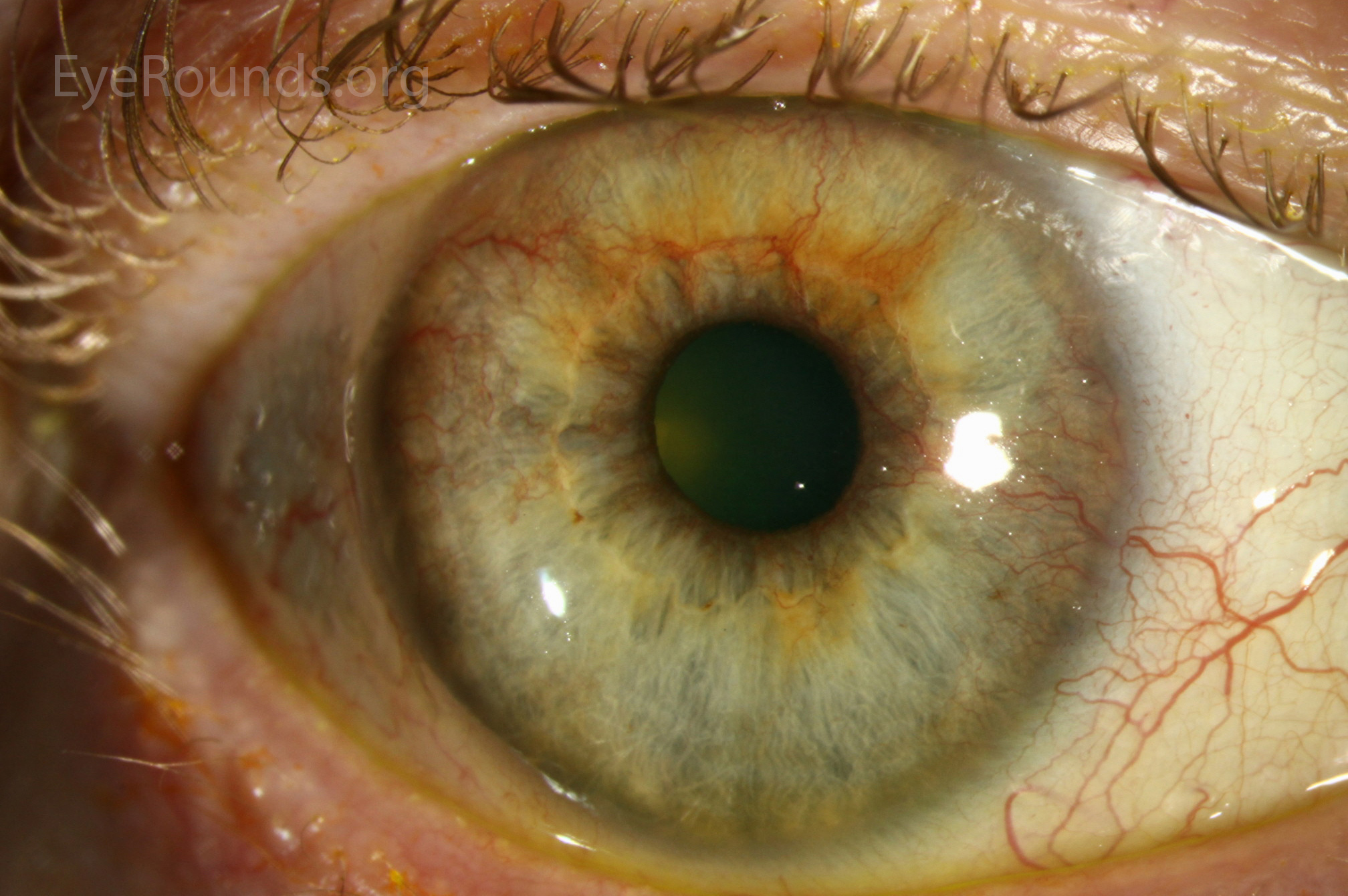 Neovascularization of the iris os