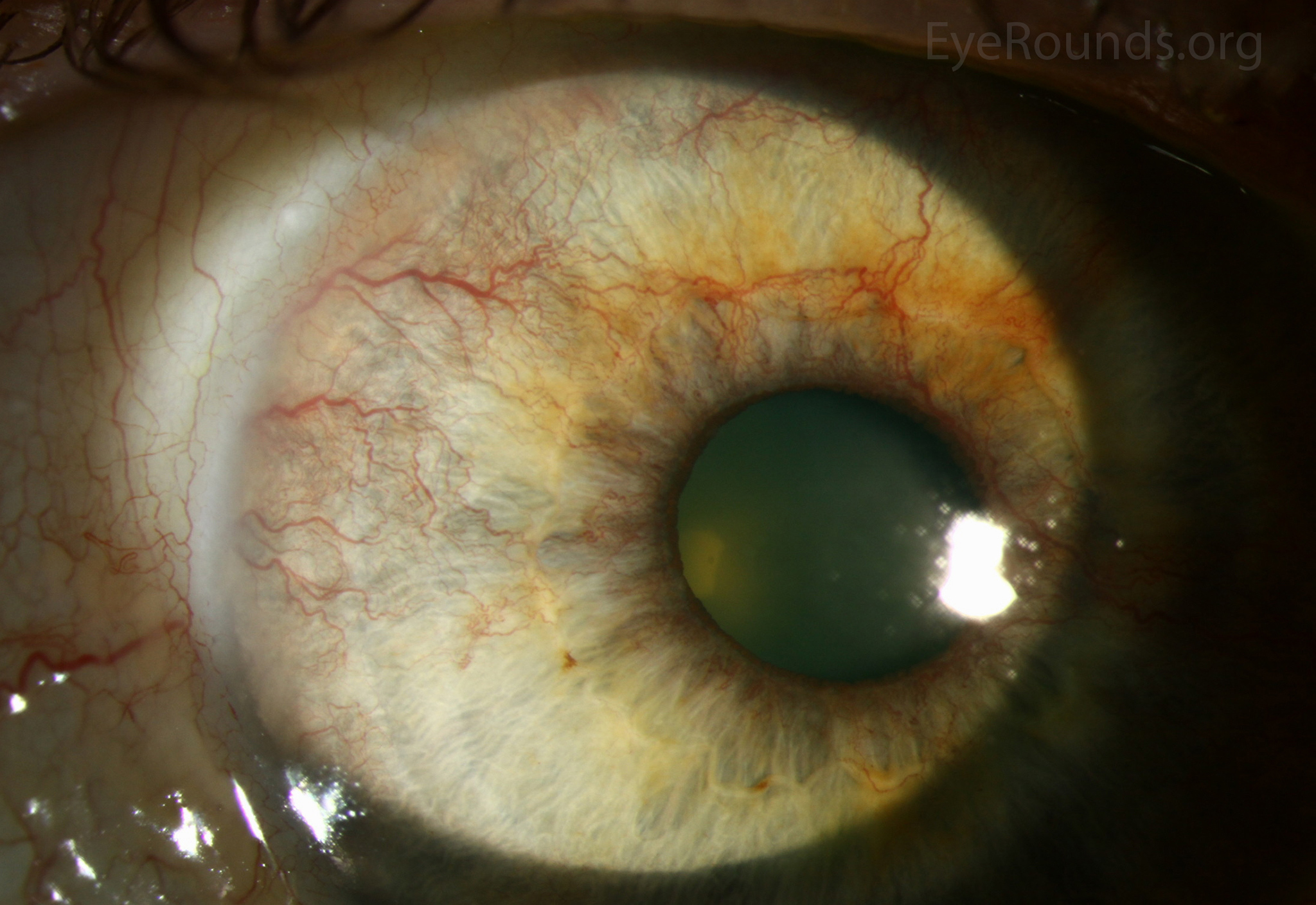 rubeosis iridis diabetic eye