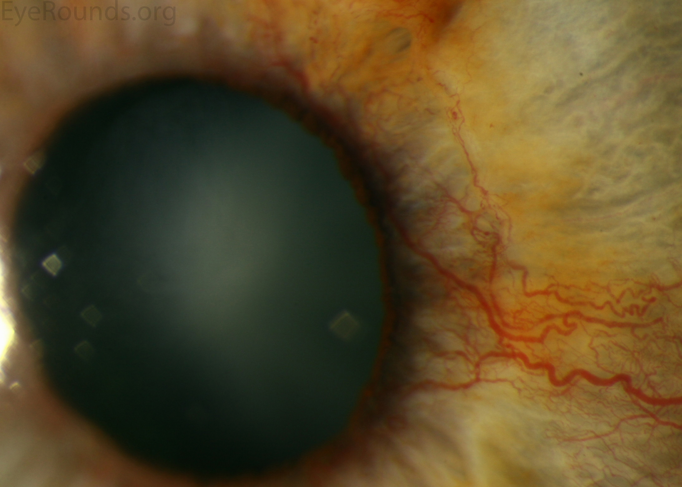 Neovascularization of the iris high magnification