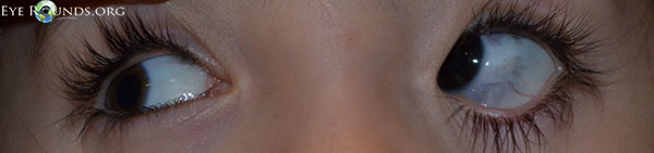 affected gaze ocular melanocytosis