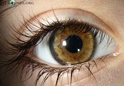 Atlas Entry Ocular Melanocytosis
