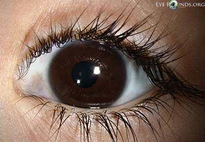 OS discoloration of the sclera melanocytosis