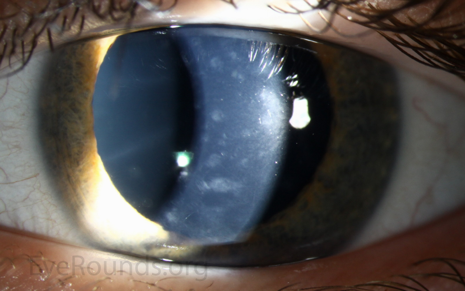 patient 3a PPMD may present with diffuse, gray-white opacities, slit lamp