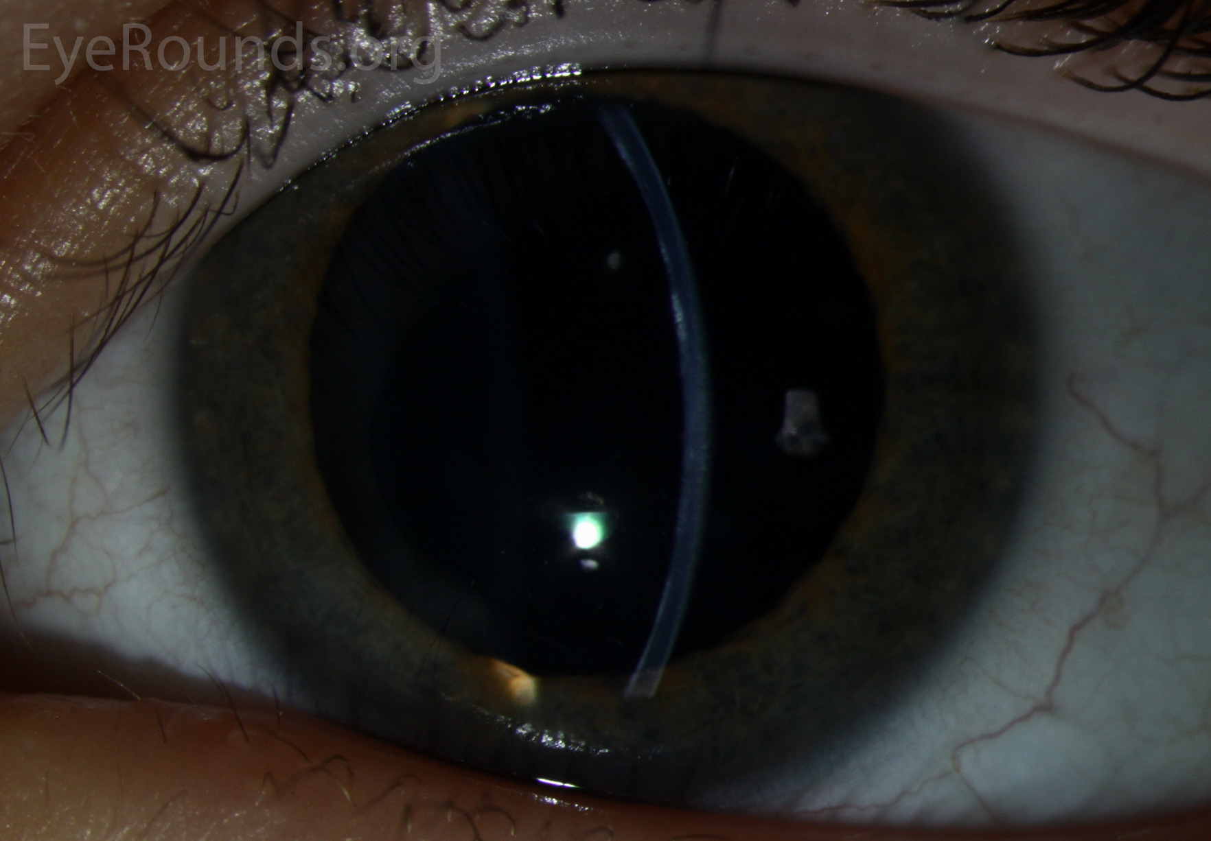 patient 3b PPMD may present with diffuse, gray-white opacities, slit lamp