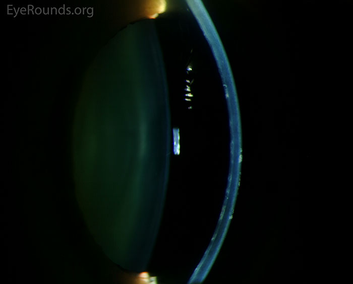 Ppcd Optometry Posterior Polymorphous Corneal Dystrophy (PPMD)