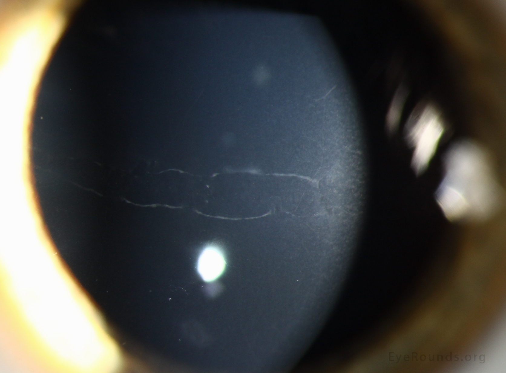 Band lesions, sometimes called 'snail tracks,' are classically horizontal lesions with parallel, scalloped, non-tapering edges at the level of the posterior cornea