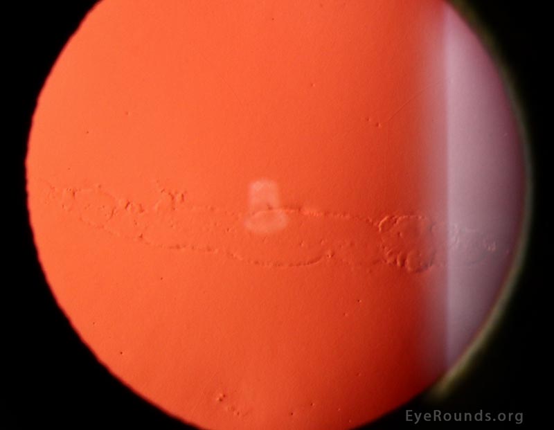 Posterior Polymorphous Corneal Dystrophy (PPMD)