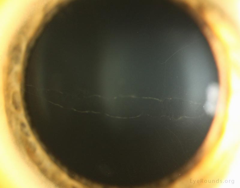 Posterior Polymorphous Corneal Dystrophy (PPMD)