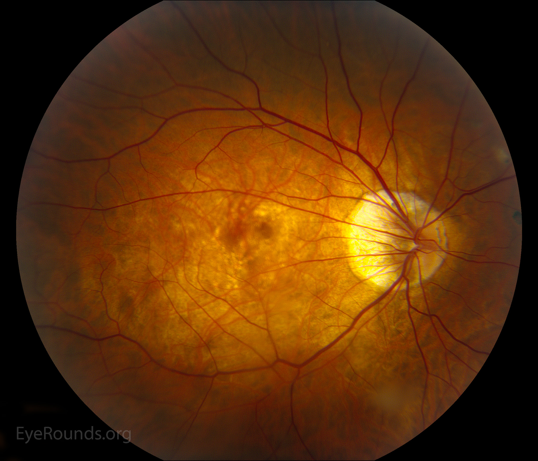 a britek eltávolítják a retina az Egyesült Arab Emírségek bejáratánál, Myopia fundus