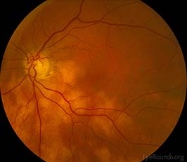 Sarcoidosis with choroidal infiltrates