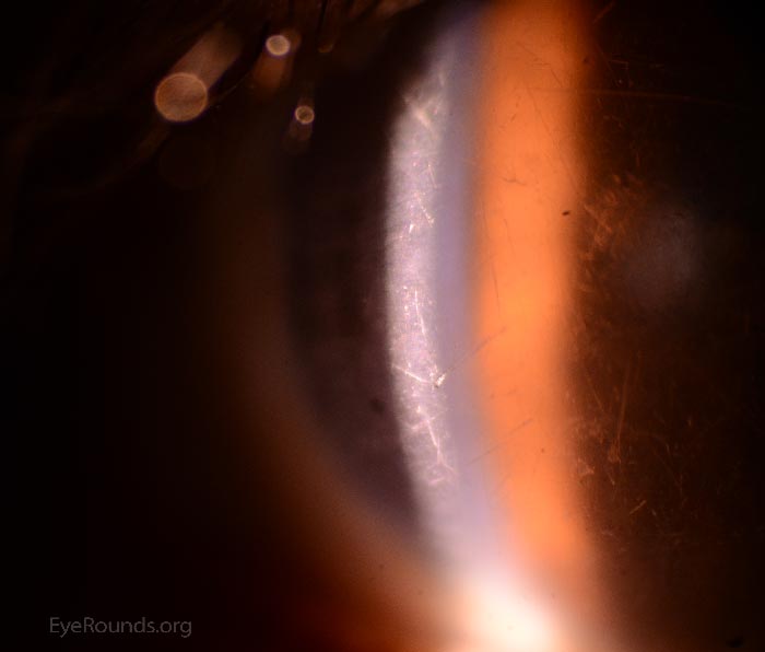 Scratched Scleral Rigid Gas Permeable (RGP) Lens