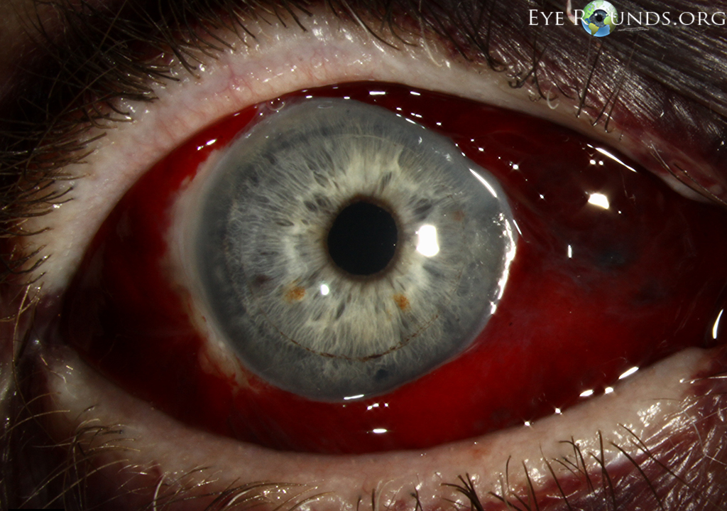 subconjunctival hemorrhage looking forward eye filled with blood