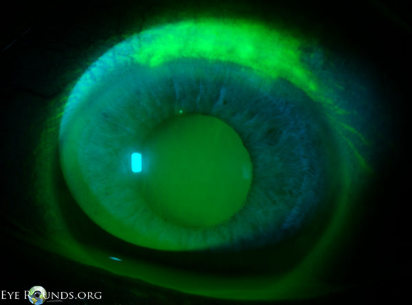 Superior limbic keratoconjunctivitis (SLK)