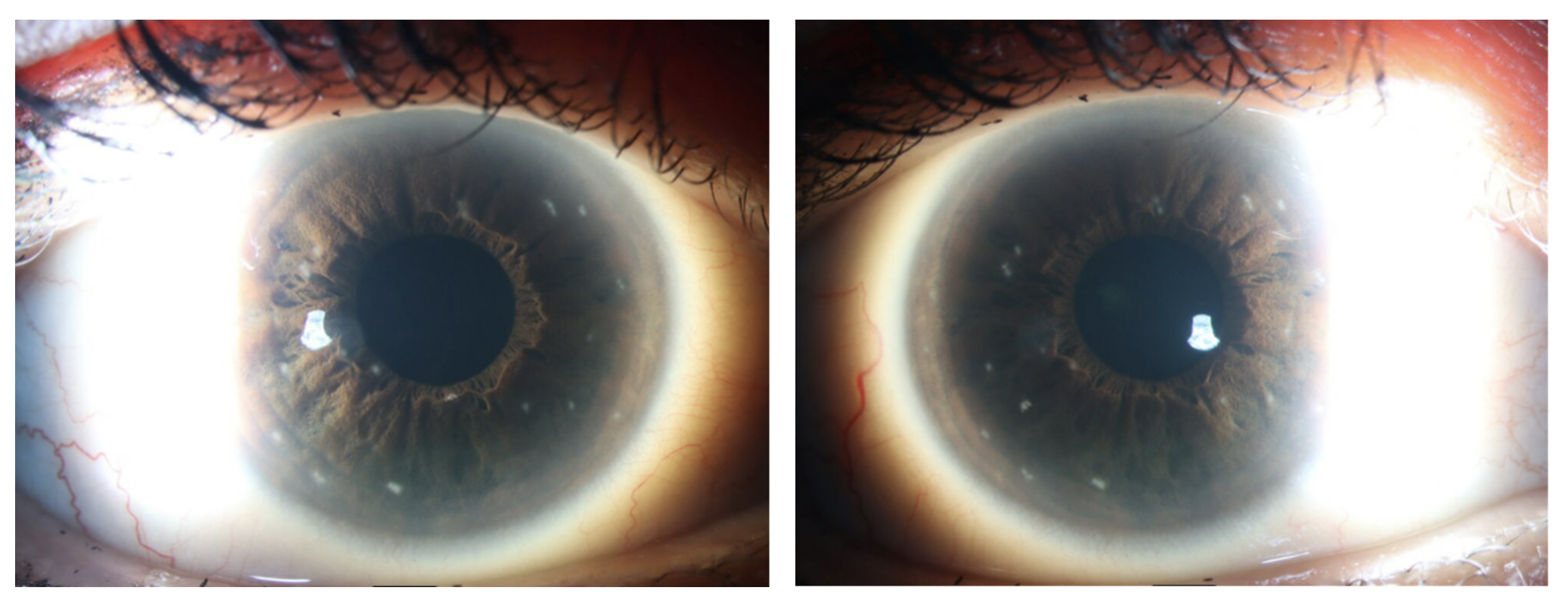 Right eye of the patient demonstrating multiple intraepithelial opacities highlighted using sclerotic scatter.