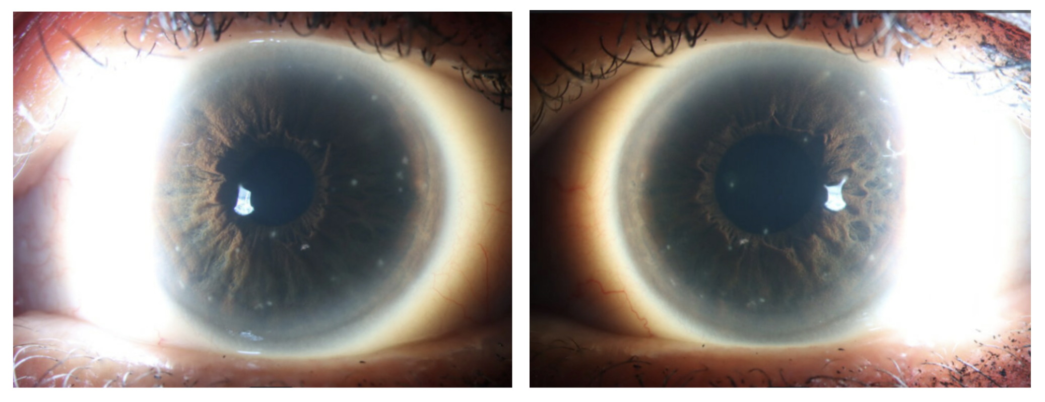 Left eye of the patient demonstrating multiple intraepithelial opacities highlighted using sclerotic scatter.