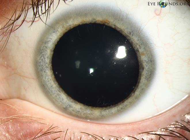 múltiples lesiones corneales ligeramente elevadas que son conglomerados redondos a ovalados de color gris, opacidades subepiteliales granulares "tipo miga""crumblike" subepithelial opacities