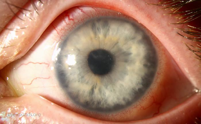 Acanthamoeba keratitis