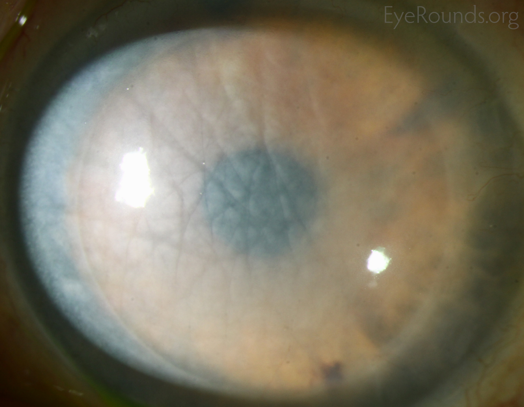 Corneal Transplant Rejection