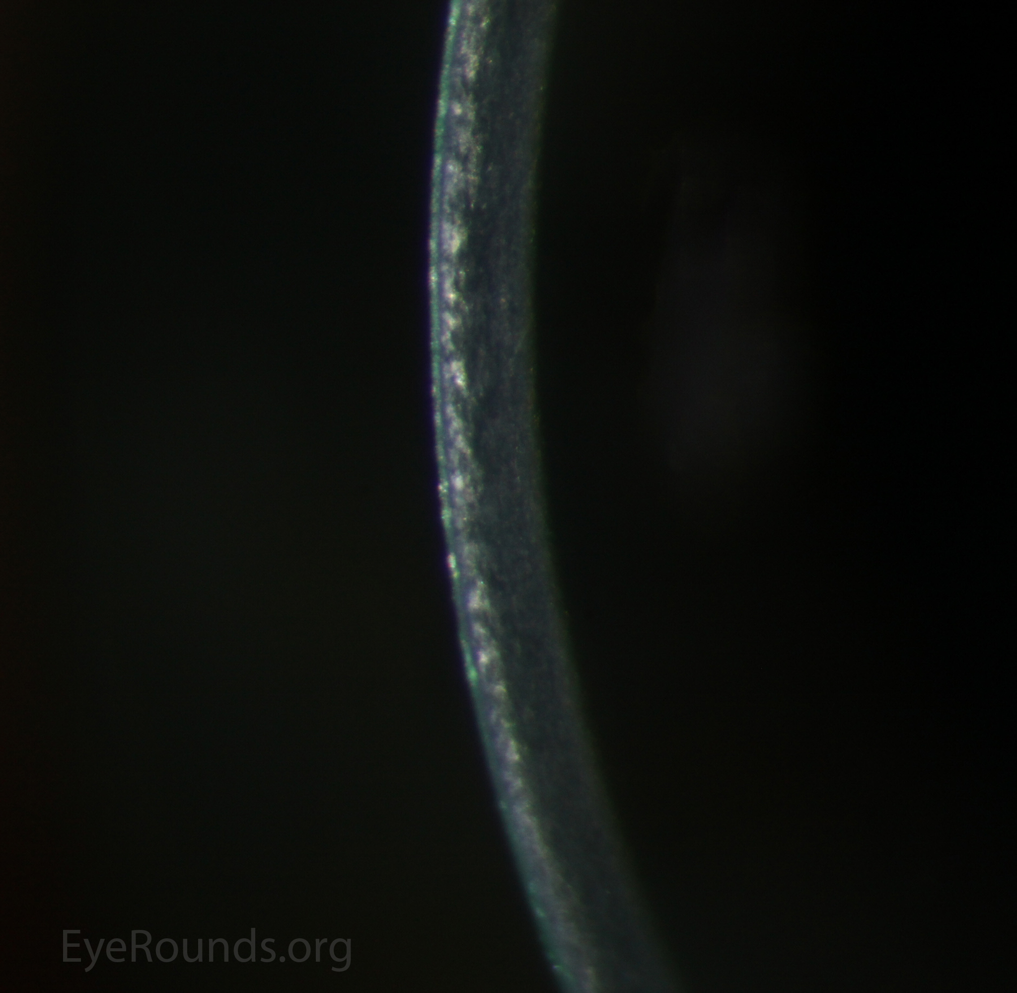 Corneal haze is most easily visible when using the slit beam seen using the slit beam - Zoomed