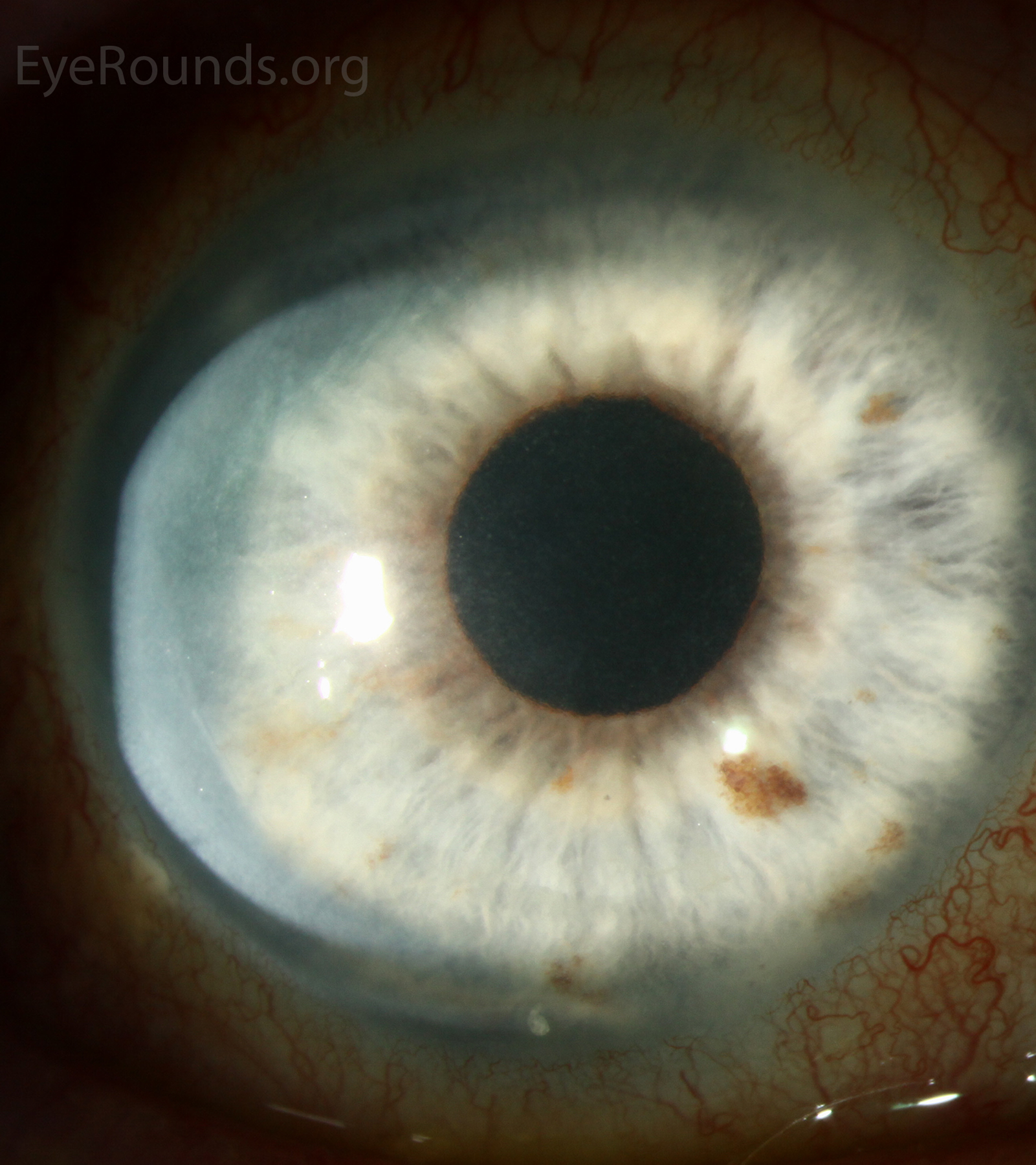 Corneal haze can be seen as a reflective region when illuminated with a broad slit beam