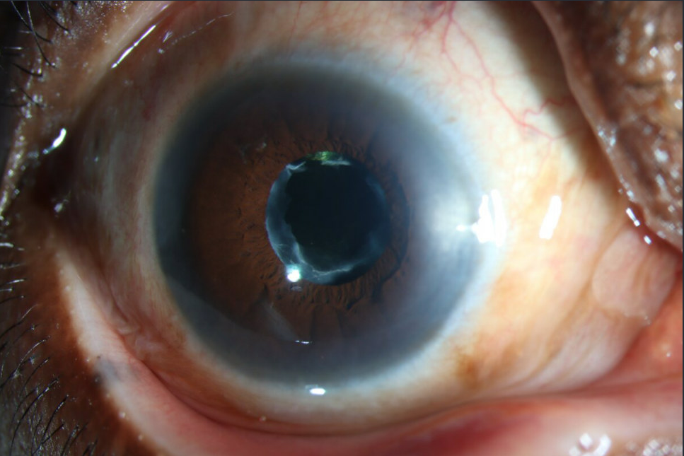 Anterior Subcapsular Catract Slit Lamp