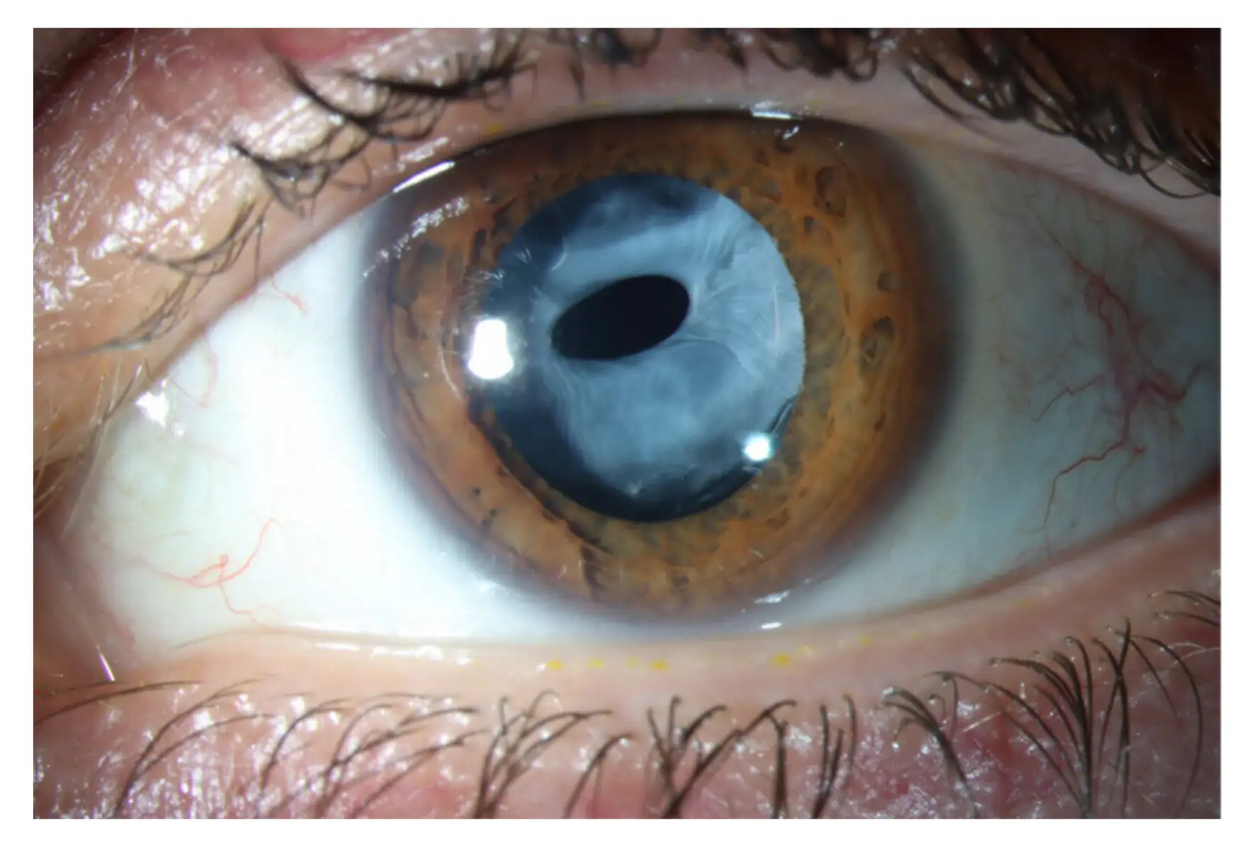  Slit lamp photograph of visually significant Anterior Capsular Phimosis