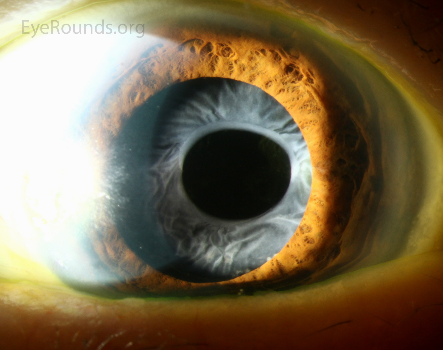Preventing and Treating Capsular Phimosis – Cataract Coach™