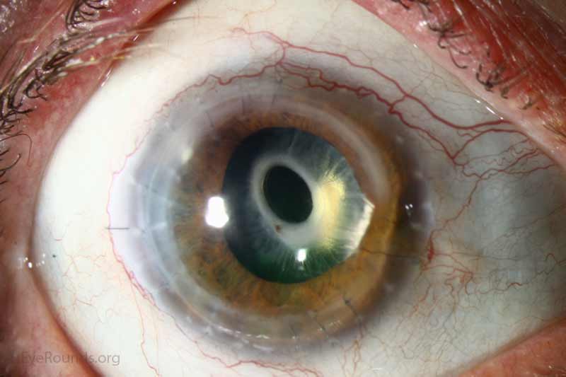 Preventing and Treating Capsular Phimosis – Cataract Coach™