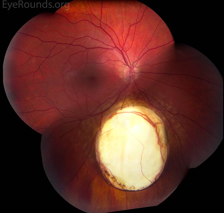 Chorioretinal coloboma