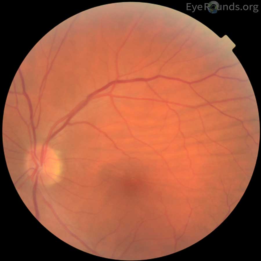 choroidal folds. EyeRounds.org: Online Ophthalmic Atlas