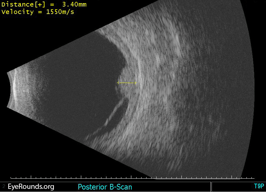B-scan ultrasound