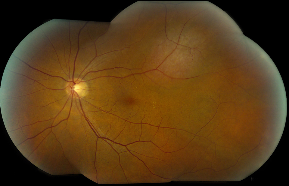 circumscribed choroidal hemangioma fundus montage figure 2