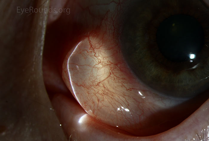 Conjunctival epithelial inclusion cyst