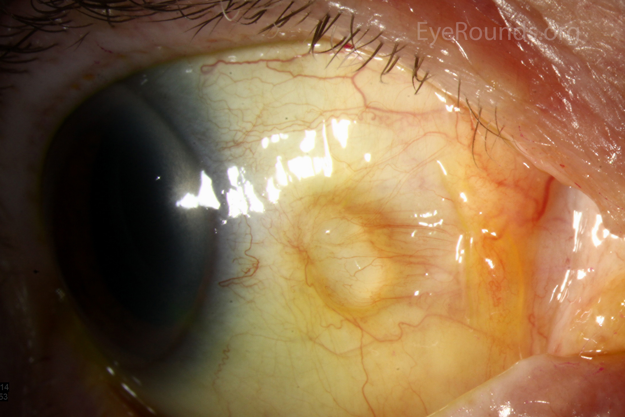 atlas-entry-conjunctival-epithelial-inclusion-cyst