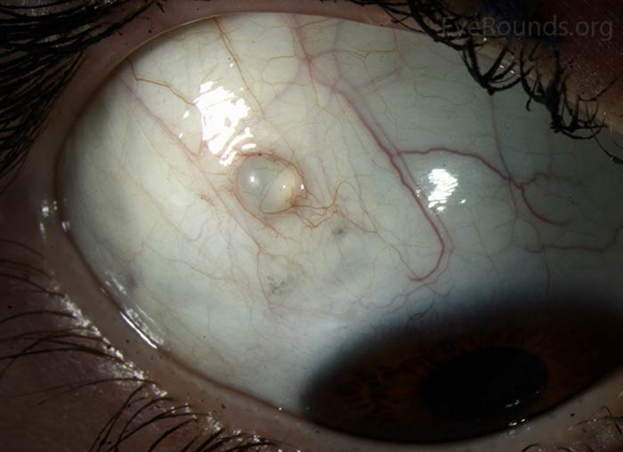 Conjunctival epithelial inclusion cyst