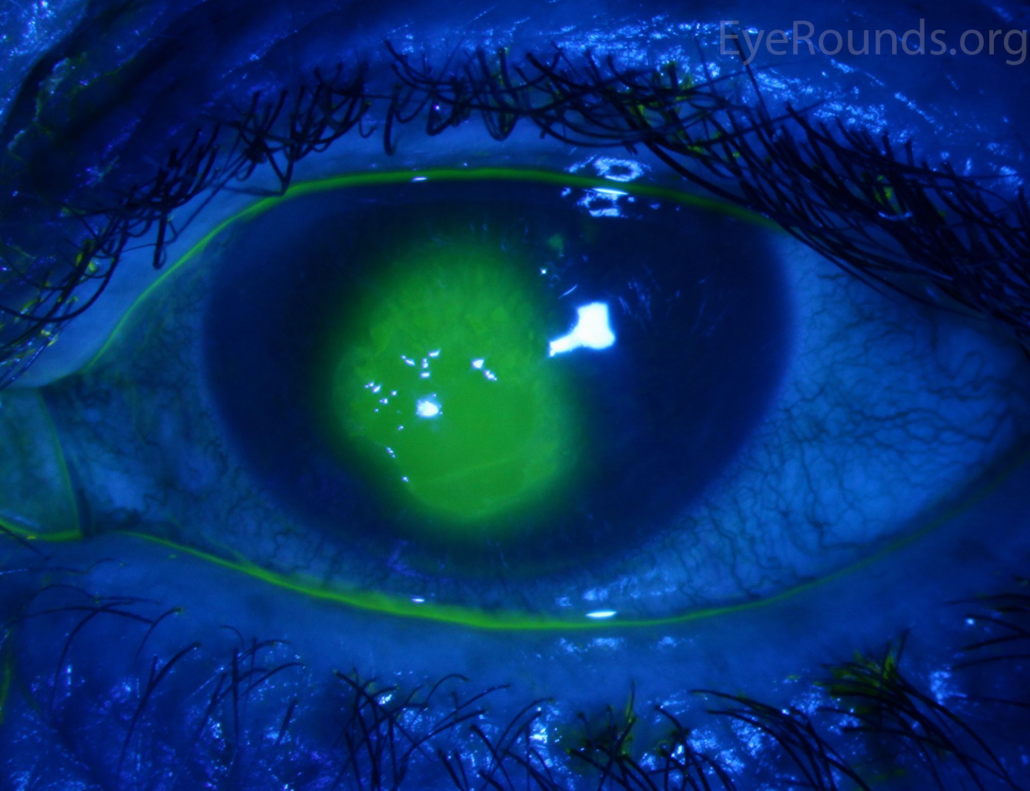 fluorescein dye corneal abrasion