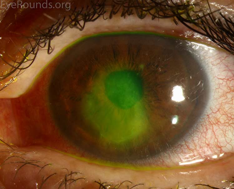 Corneal Abrasion