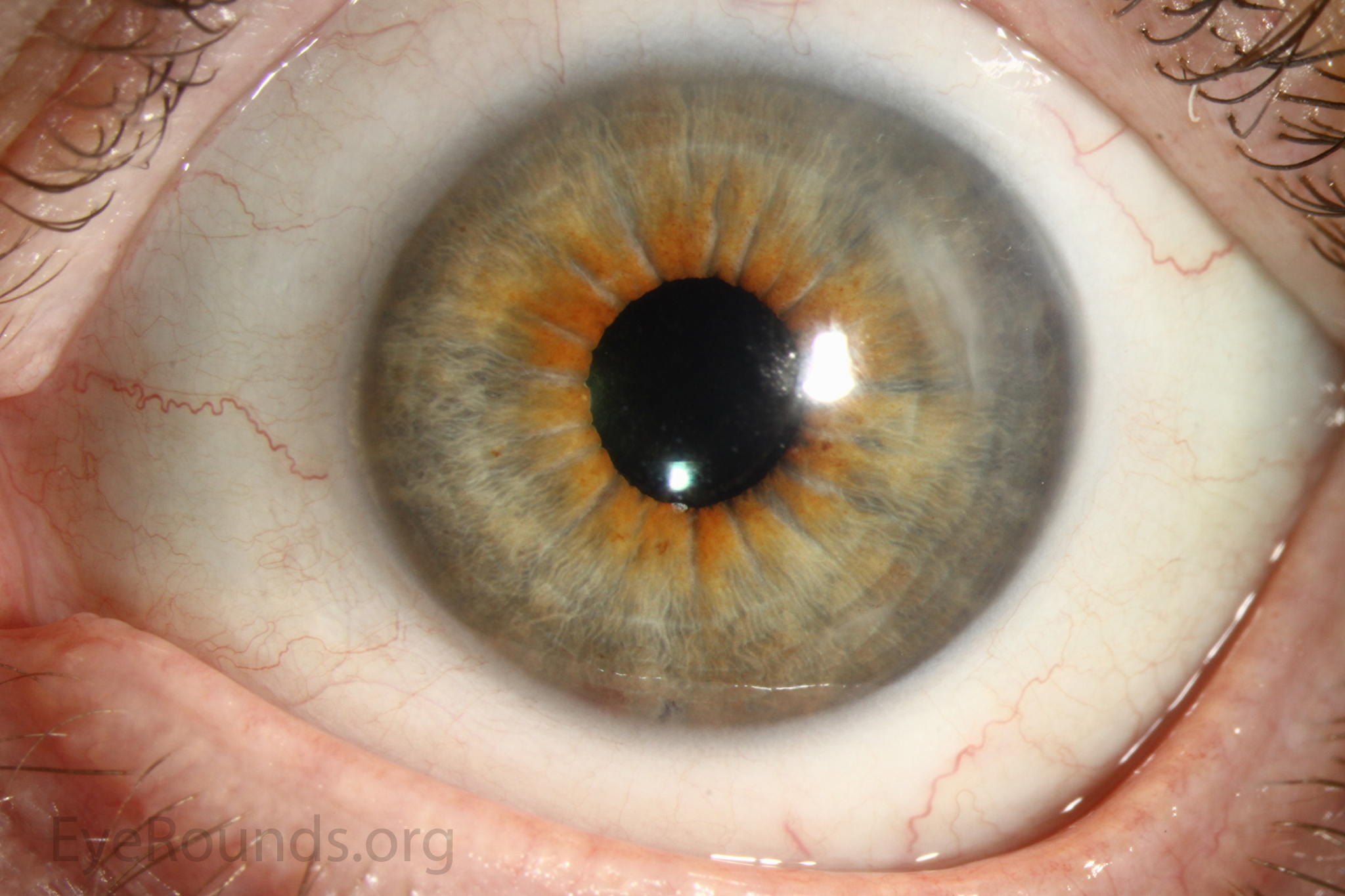  The appearance 1 month after surgery with a clear cornea