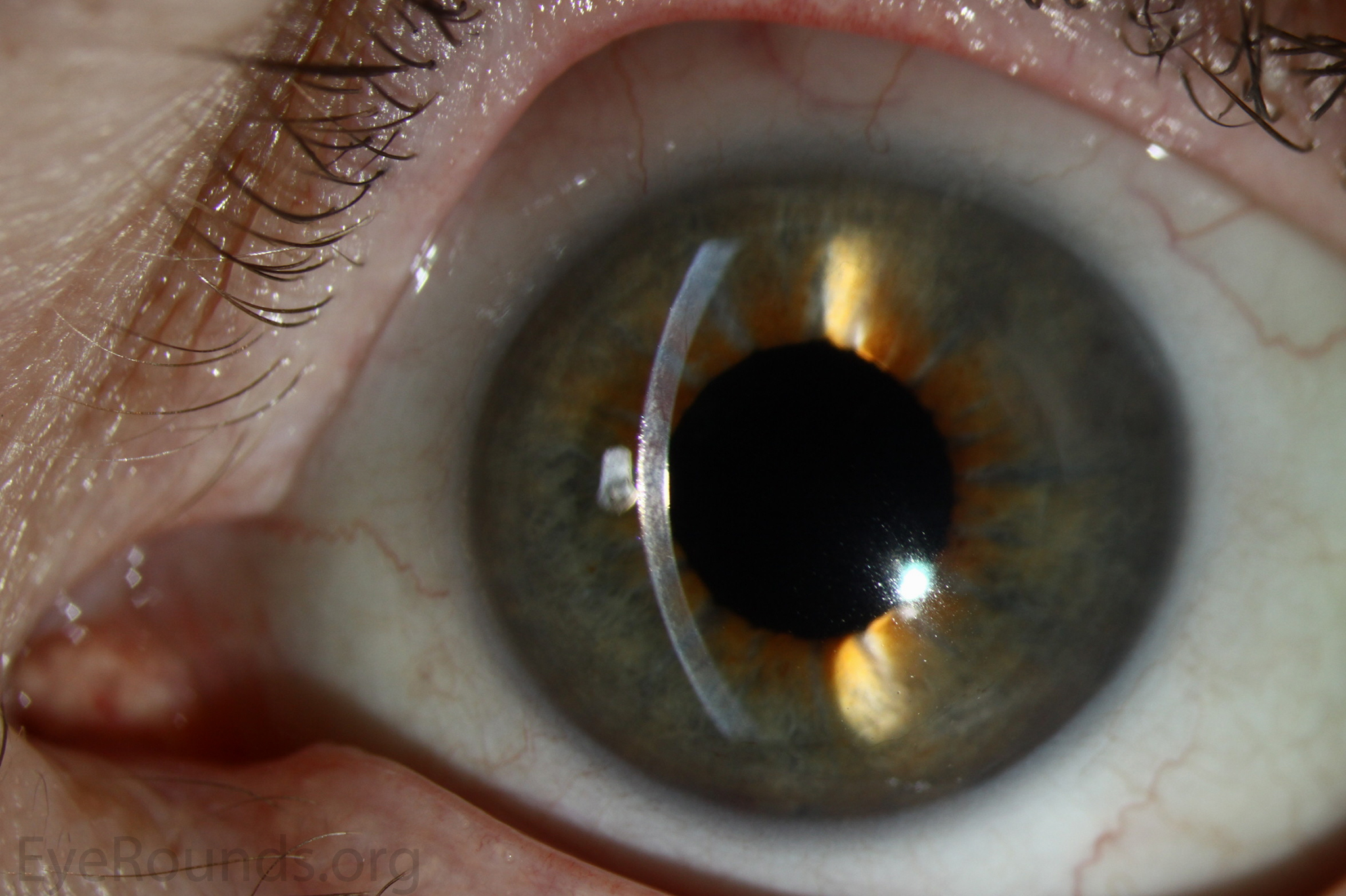 The appearance 1 month after surgery with a clear cornea second example