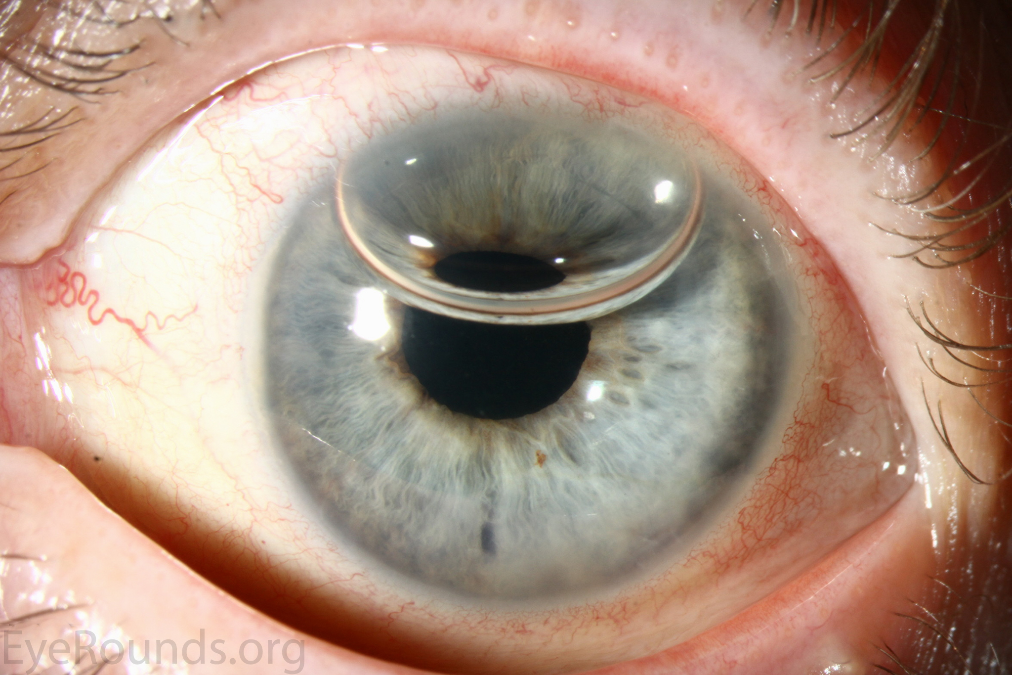 post-operative appearance of patientd who underwent DMEK for Fuchs endothelial corneal dystrophy at 1 week post-operatively with residual anterior chamber gas bubbles