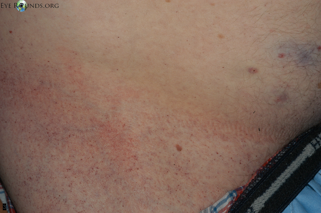 Skin angiokeratoma - Fabry Disease